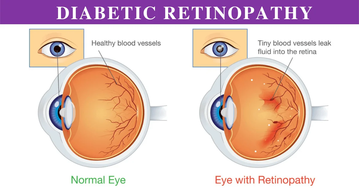 Diabetic Retinopathy treatment in chennai